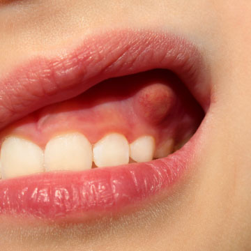 前往牙齒清潔不佳會形成「牙周囊袋」，我們教您如何治療內頁