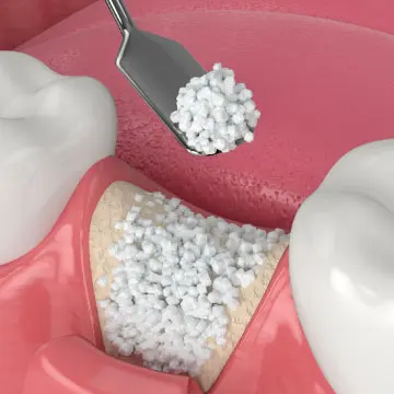 桃園牙醫-薇拉牙醫診所-牙齒矯正-排列不整案例