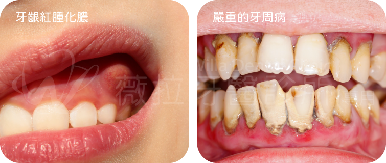 牙周病成見症狀：牙結石、牙齦紅腫、牙周囊袋發炎、牙齦出血、牙齒晃動、掉牙