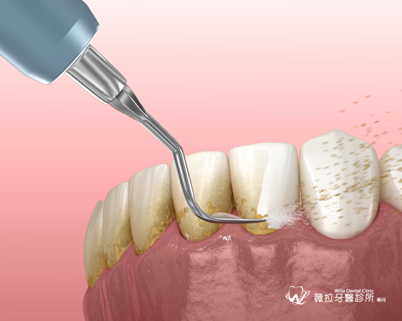 定期洗牙有助於維持牙齒健康，避免牙周病的發生