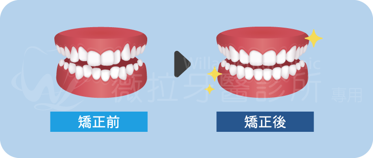 牙齒矯正前後差異圖