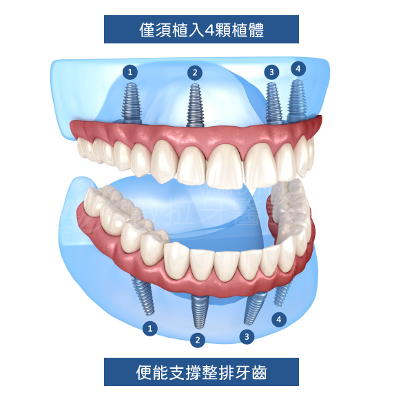 All-on-4全口重建僅需植入4顆植體，便能支撐整排牙齒