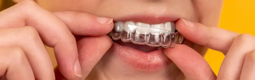 桃園牙醫-薇拉牙醫診所-牙齒矯正-傳統矯正與隱形矯正